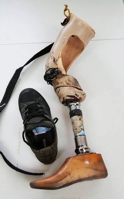 What is the Cost of a Prosthetic Leg?